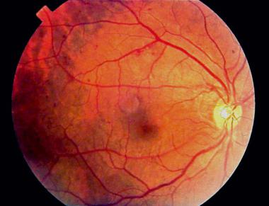 Deep Learning in Julia to Detect Diabetic Retinopathy on POWER+GPUs ...